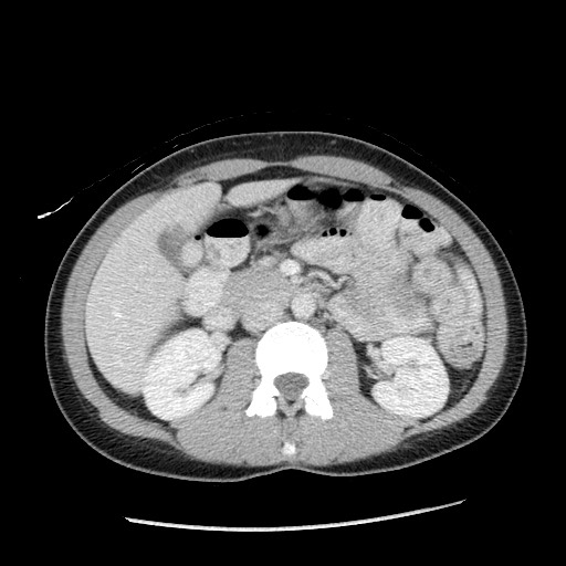 Castleman disease with fibrous pseudotumor in the abdomen (Radiopaedia 77296-89373 A 51).jpg