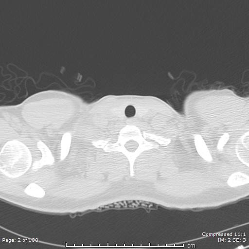 Catamenial pneumothorax (Radiopaedia 54382-60600 Axial non-contrast 2).jpg