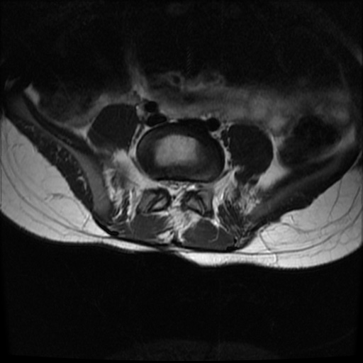 File:Caudal regression syndrome type 1 (Radiopaedia 82213-96267 Axial T2 19).jpg
