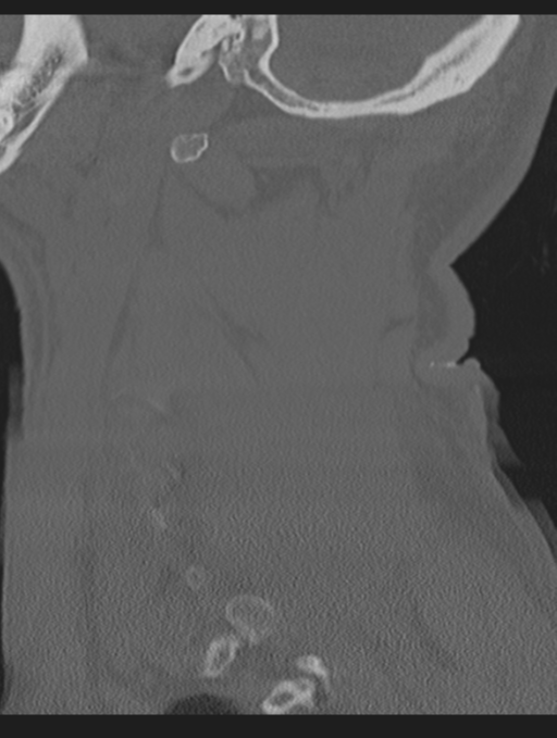 Cavernoma of cervical cord (Radiopaedia 50838-56346 Sagittal bone window 66).png