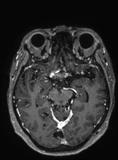 Cavernous hemangioma of the cerebellar falx (Radiopaedia 73025-83724 Axial T1 C+ 201).jpg