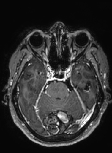 Cavernous hemangioma of the cerebellar falx (Radiopaedia 73025-83724 Axial T1 C+ 231).jpg