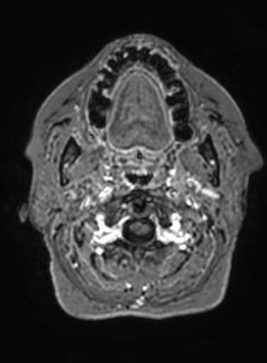 Cavernous hemangioma of the cerebellar falx (Radiopaedia 73025-83724 Axial T1 C+ 343).jpg