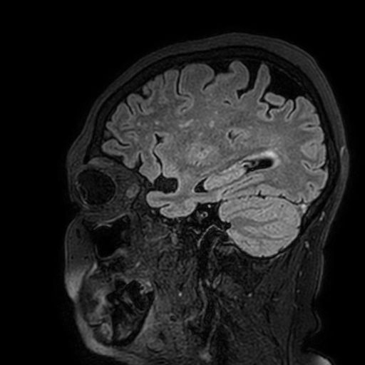 Cavernous hemangioma of the cerebellar falx (Radiopaedia 73025-83724 Sagittal FLAIR 161).jpg