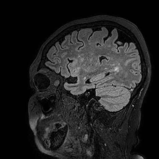 Cavernous hemangioma of the cerebellar falx (Radiopaedia 73025-83724 Sagittal FLAIR 164).jpg