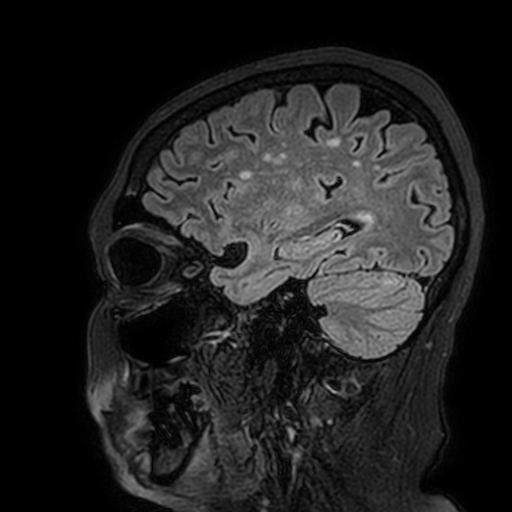Cavernous hemangioma of the cerebellar falx (Radiopaedia 73025-83724 Sagittal FLAIR 54).jpg