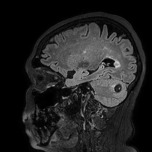 File:Cavernous hemangioma of the cerebellar falx (Radiopaedia 73025-83724 Sagittal FLAIR 64).jpg