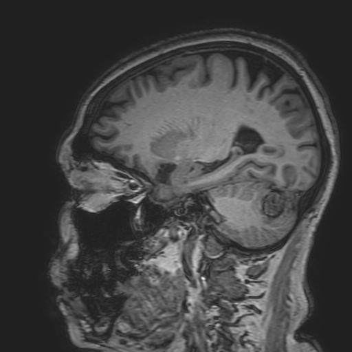 File:Cavernous hemangioma of the cerebellar falx (Radiopaedia 73025-83724 Sagittal T1 74).jpg