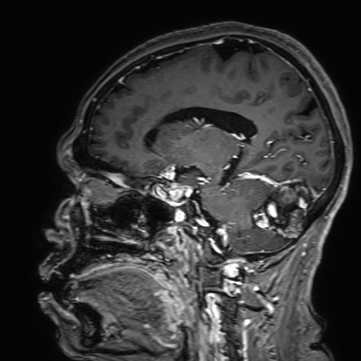Cavernous hemangioma of the cerebellar falx (Radiopaedia 73025-83724 Sagittal T1 C+ 127).jpg
