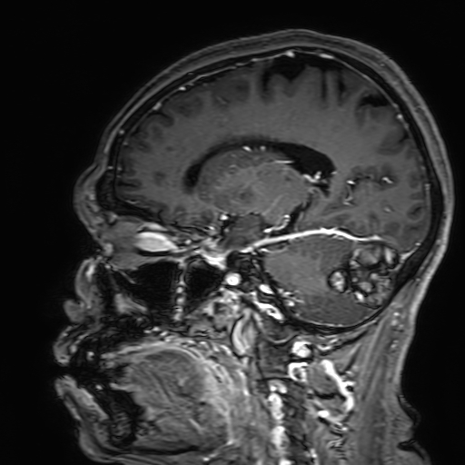 File:Cavernous hemangioma of the cerebellar falx (Radiopaedia 73025-83724 Sagittal T1 C+ 131).jpg