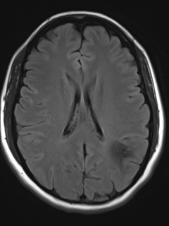 File:Cavernous malformation (cavernous angioma or cavernoma) (Radiopaedia 36675-38237 Axial T2 FLAIR 13).png