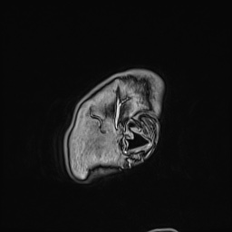 Cavernous sinus meningioma (Radiopaedia 63682-72367 Sagittal T1 C+ 16).jpg