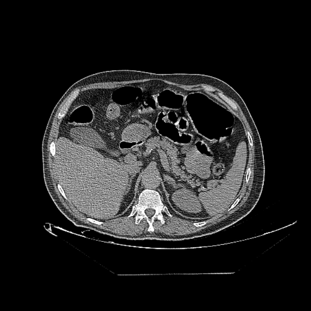 Cavitating bronchogenic carcinoma (Radiopaedia 44489-48162 Axial non-contrast 91).jpg