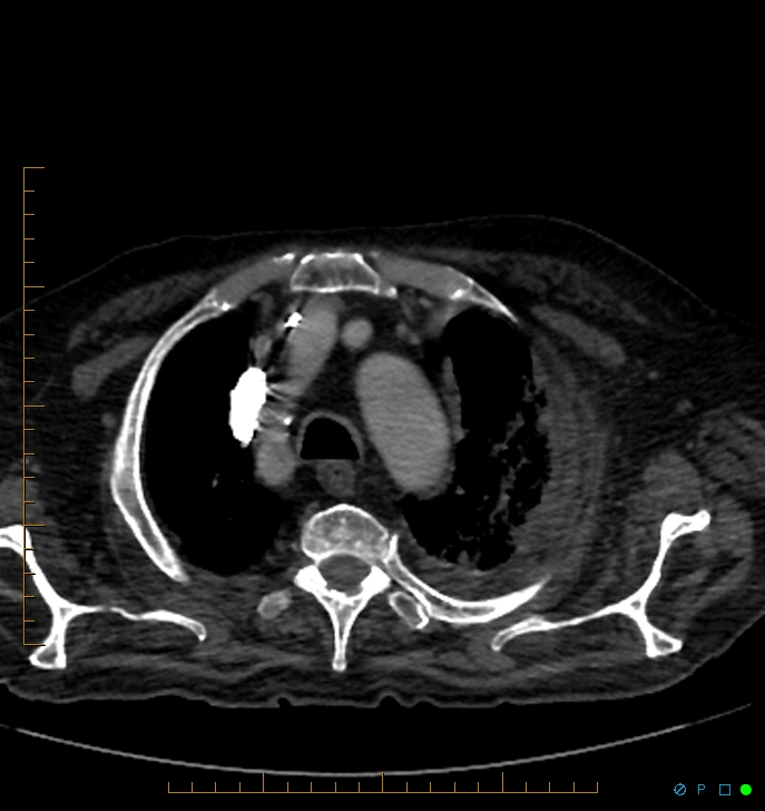 Cavitating pulmonary infarction (Radiopaedia 54634-60849 Axial C+ CTPA 7).jpg