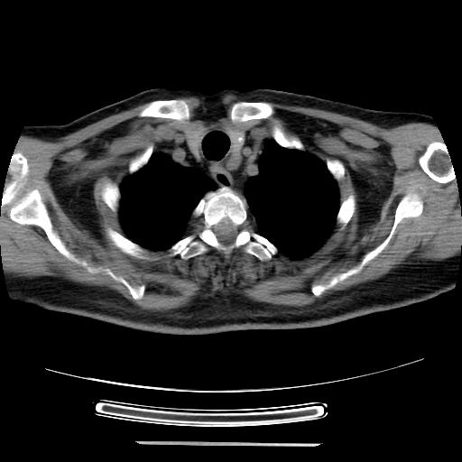 File:Cavitating pulmonary metastases (Radiopaedia 89545-106544 Axial non-contrast 6).jpg