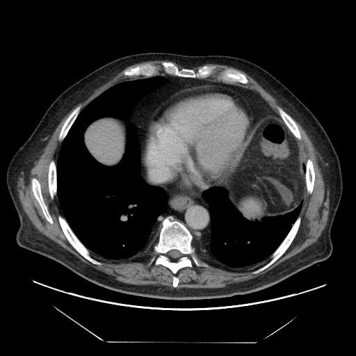 Cecal adenocarcinoma (Radiopaedia 64871-73817 A 4).jpg