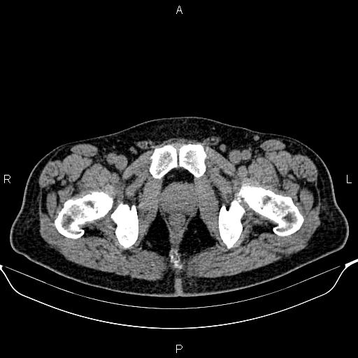 Cecal adenocarcinoma (Radiopaedia 85324-100916 Axial non-contrast 101).jpg