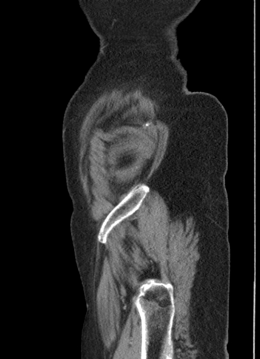 Cecal adenocarcinoma - surgical scar recurrence (Radiopaedia 79988-93264 D 6).jpg