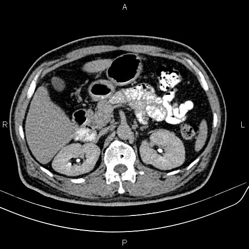 File:Cecal cancer with appendiceal mucocele (Radiopaedia 91080-108651 Axial C+ delayed 16).jpg