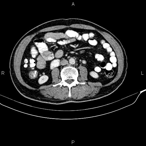 File:Cecal cancer with appendiceal mucocele (Radiopaedia 91080-108651 B 57).jpg