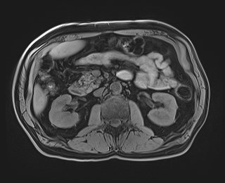 Cecal mass causing appendicitis (Radiopaedia 59207-66532 Axial T1 60).jpg