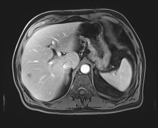 Cecal mass causing appendicitis (Radiopaedia 59207-66532 T1 C+ PV phase 36).jpg