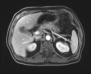 Cecal mass causing appendicitis (Radiopaedia 59207-66532 T1 C+ PV phase 45).jpg