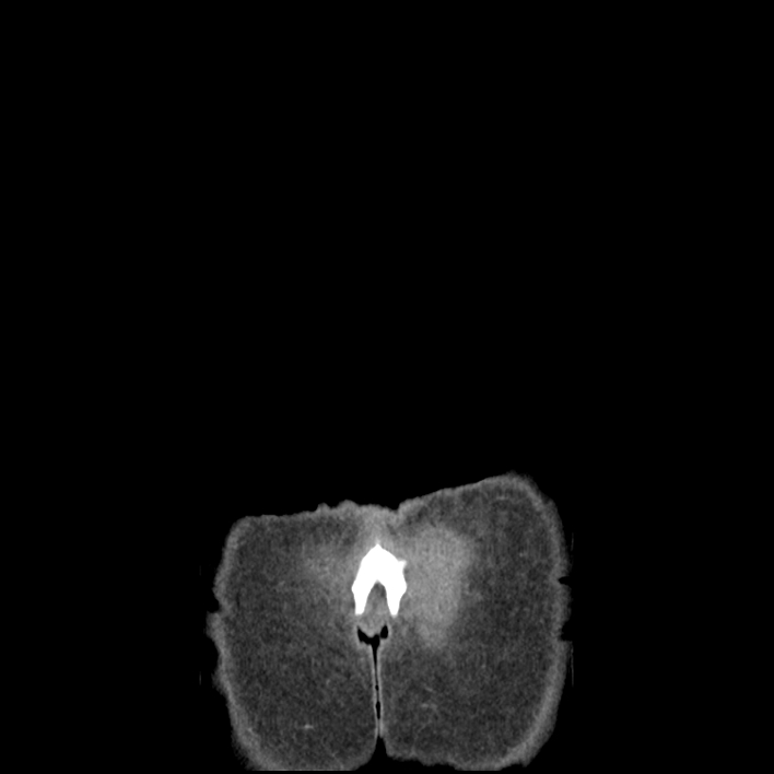 Cecal volvulus (Radiopaedia 69527-79408 B 75).jpg