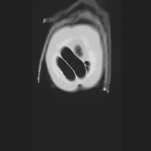 Cecal volvulus (Radiopaedia 75378-86620 Coronal lung window 13).jpg