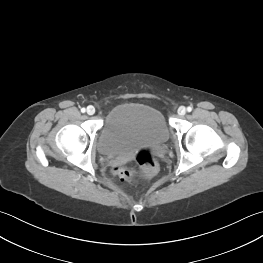 Cecum hernia through the foramen of Winslow (Radiopaedia 46634-51112 A 70).png