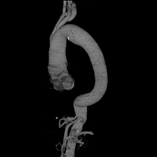 File:Celiac artery aneurysm (Radiopaedia 21574-21525 C 6).JPEG