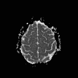 File:Central-variant posterior reversible encephalopathy syndrome (PRES) (Radiopaedia 43880-47358 Axial ADC 19).jpg