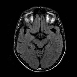 File:Central-variant posterior reversible encephalopathy syndrome (PRES) (Radiopaedia 43880-47359 Axial FLAIR 9).jpg