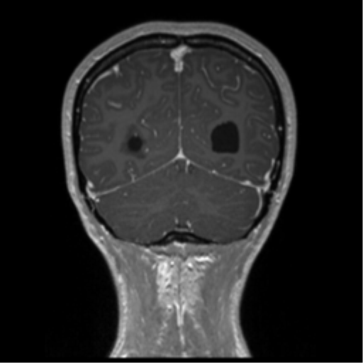 Central neurocytoma (Radiopaedia 37664-39557 Coronal T1 C+ 19).png
