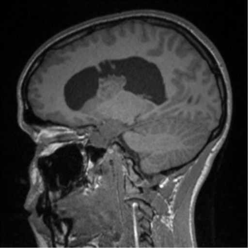 Central neurocytoma (Radiopaedia 37664-39557 Sagittal T1 40).png
