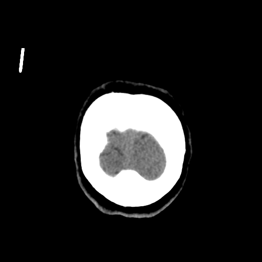 Central neurocytoma (Radiopaedia 65317-74346 Coronal non-contrast 59).png