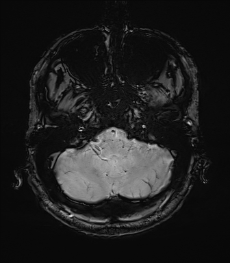 File:Central neurocytoma (Radiopaedia 71068-81303 Axial SWI 6).jpg