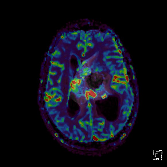 File:Central neurocytoma (Radiopaedia 84497-99872 Axial Perfusion 131).jpg