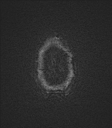 File:Central neurocytoma (Radiopaedia 84497-99872 Axial SWI 70).jpg