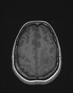 Central neurocytoma (Radiopaedia 84497-99872 Axial T1 152).jpg