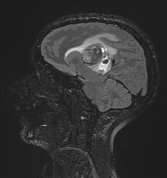 Central neurocytoma (Radiopaedia 84497-99872 Sagittal Flair + Gd 88).jpg