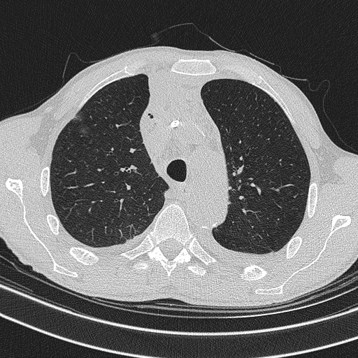 Central venous catheter tip extravasation (Radiopaedia 82828-97113 Axial lung window 27).jpg