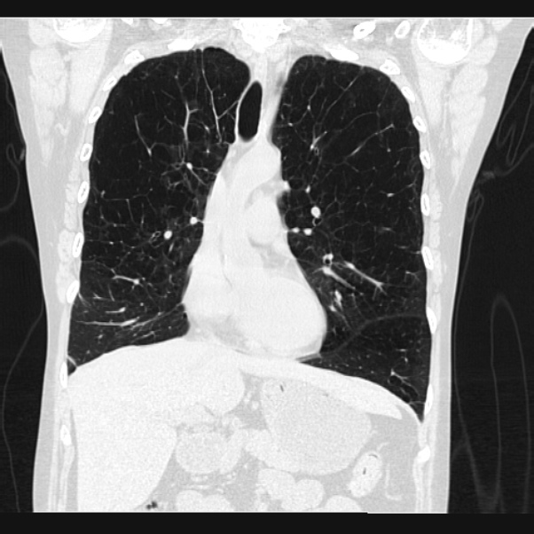 Centrilobular pulmonary emphysema (Radiopaedia 24495-24789 Coronal lung window 30).jpg