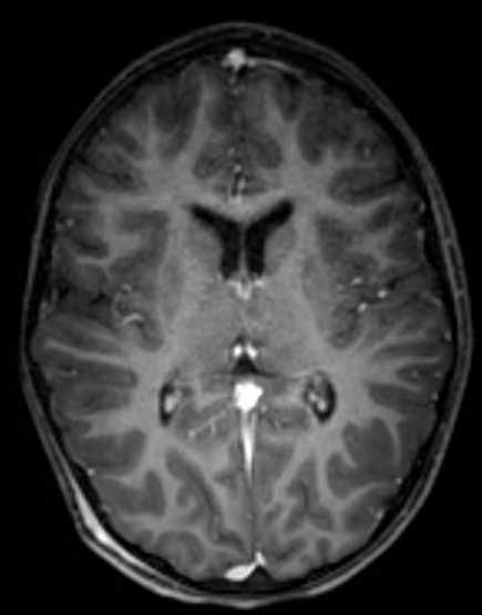 Cerebellar abscess (Radiopaedia 73727-84563 Axial T1 C+ fat sat 67).jpg