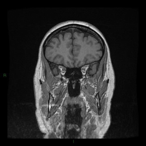 Cerebellar abscess (Radiopaedia 78135-90678 Coronal T1 C+ 43).jpg