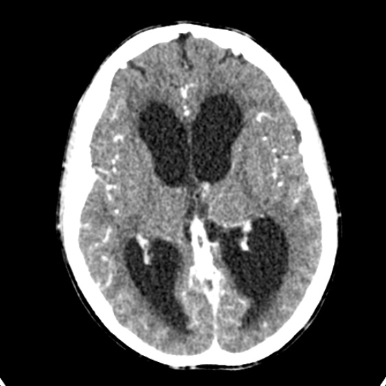 Cerebellar abscess secondary to mastoiditis (Radiopaedia 26284-26412 Axial C+ delayed 80).jpg