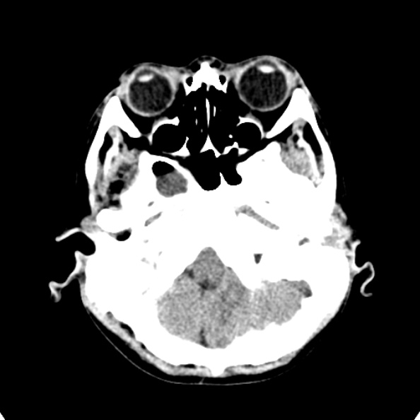 Cerebellar abscess secondary to mastoiditis (Radiopaedia 26284-26412 Axial non-contrast 23).jpg