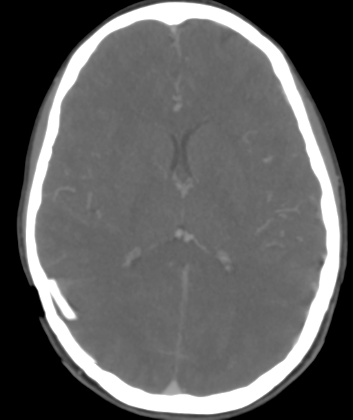 Cerebellar arteriovenous malformation- with hemorrhage (Radiopaedia 35752-37297 B 29).png