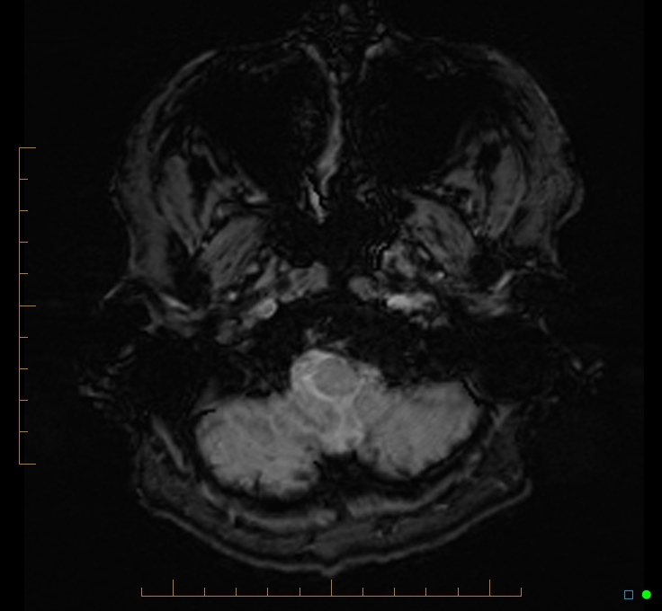 Cerebellar gangliocytoma (Radiopaedia 65377-74422 Axial SWI 4).jpg
