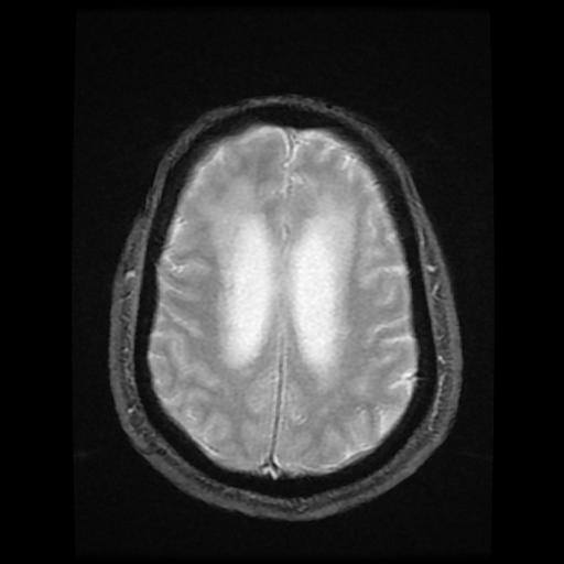 File:Cerebellar hemangioblastoma (Radiopaedia 88055-104622 Axial Gradient Echo 15).jpg